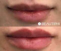 Beautiphi lip injection